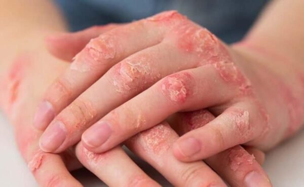 Clínica Pro-Result: Psoríase e Artrite Psoriásica: sintomas, diagnóstico e os tratamentos que mudaram o jogo
