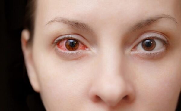 ​Tempo seco, fumaça e calor aumentam o desconforto nos olhos; especialista orienta sobre os cuidados